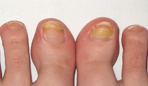 nail fungus stages
