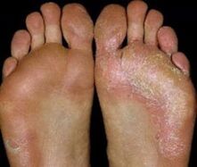 Feet with ringworm