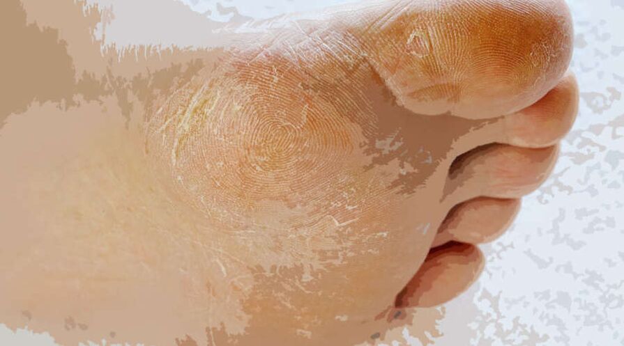 Ringworm of the foot