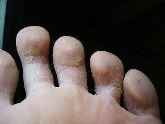 how is the fungus on the feet