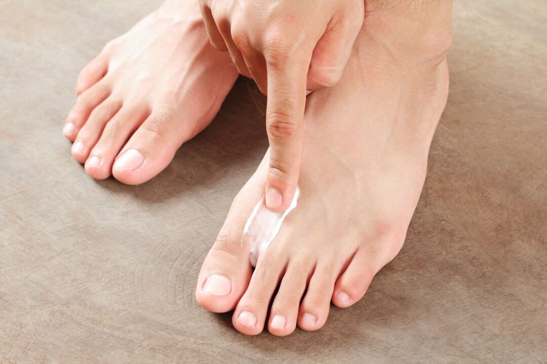 foot fungus treatment with ointment