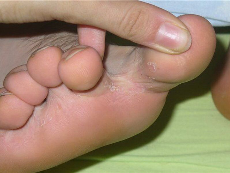 fungus between the toes, photo 1