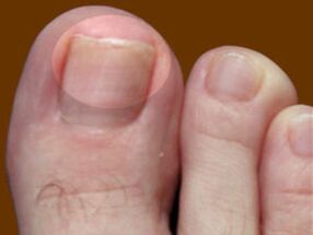 Nail fungus - an indication for the use of fungicidal drops