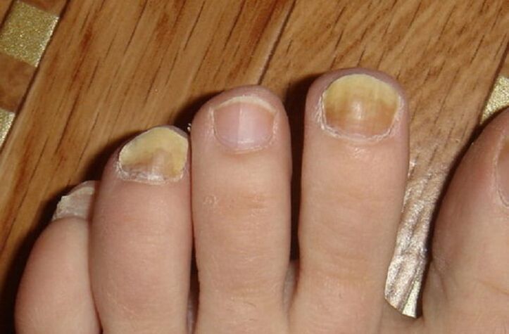 symptoms of toenail and toenail fungus