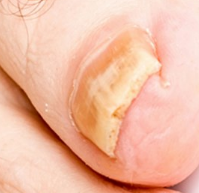 The affected fungus nail
